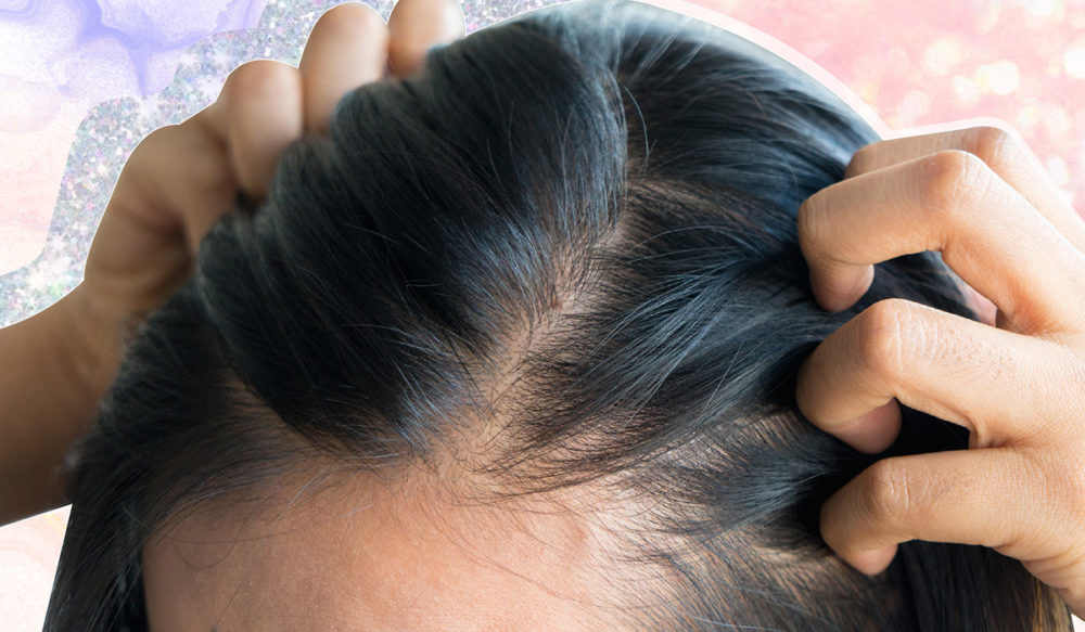 Postpartum Hair Loss